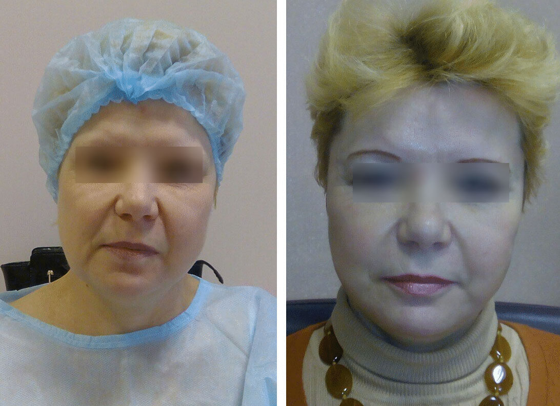 Ритидопластика подтяжка лица фото до и после в Эстемед 