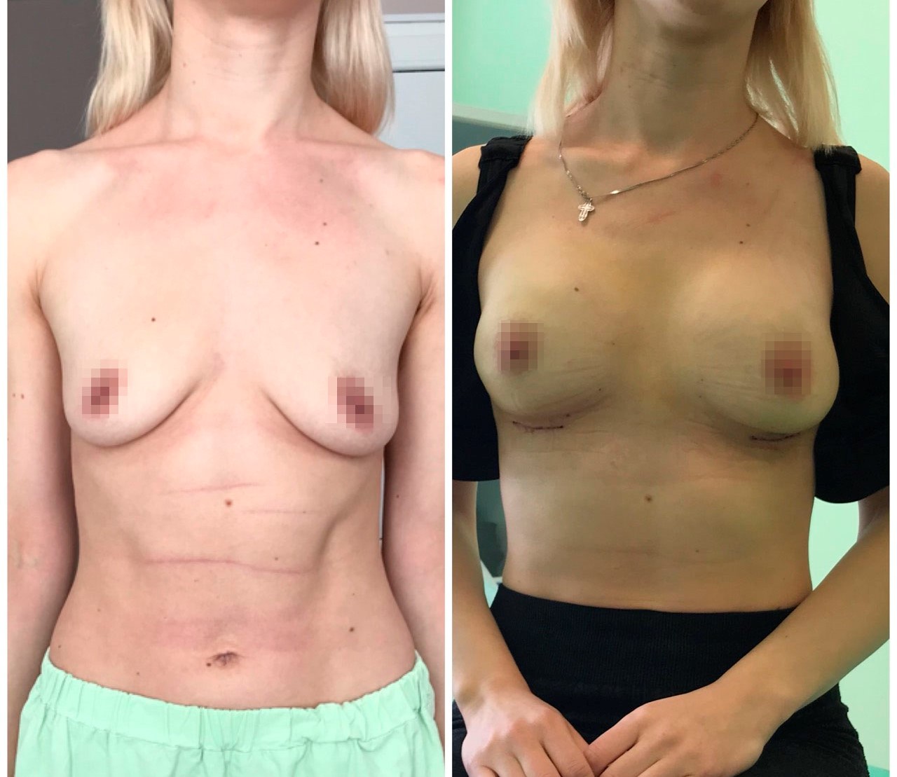 Увеличение груди фото До и После